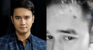 JM De Guzman injury