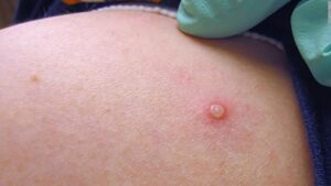 Monkeypox Local Transmission in PH