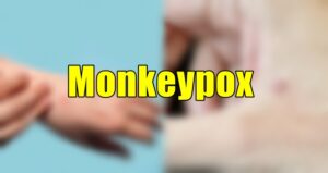 Monkeypox Pictures