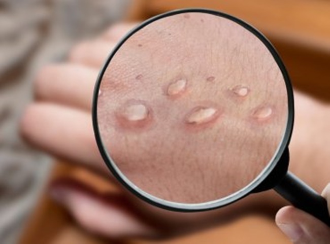Monkeypox Symptoms