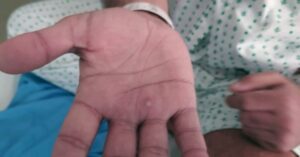 Monkeypox Transmission