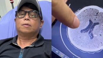 Arnold Clavio Stroke