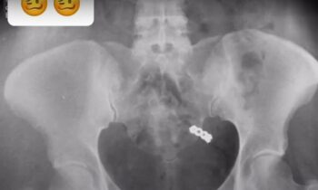 Woman Accidentally Swallows Wedding Ring W/ Vitamins | Newspapers