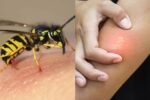 bee sting